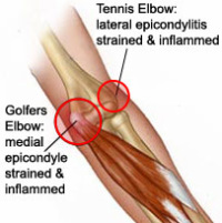 Elbow Tendinitis