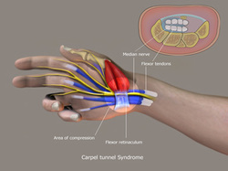 Carpal tunnel Syndrome
